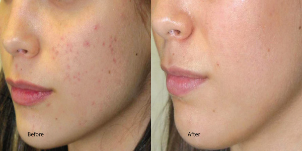 Chemical Peel Before and After