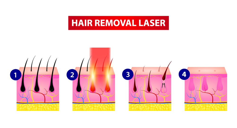 Laser Hair Removal Near Me
