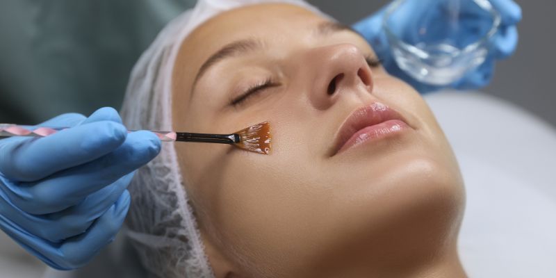 Chemical Peel for Pigmentation