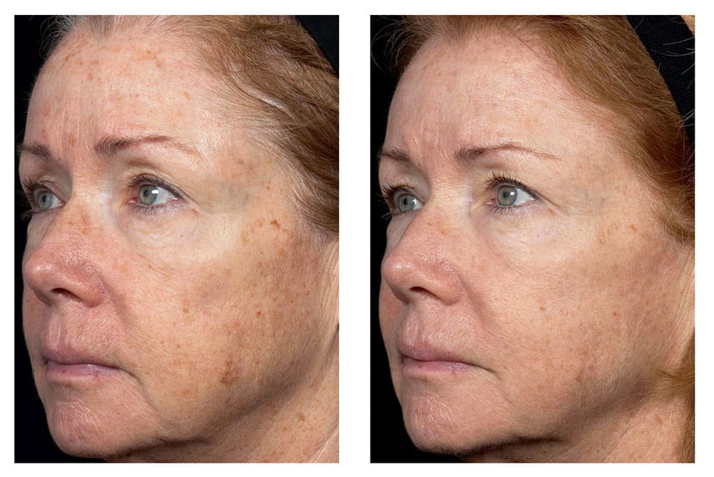 Laser Fraxel Treatment