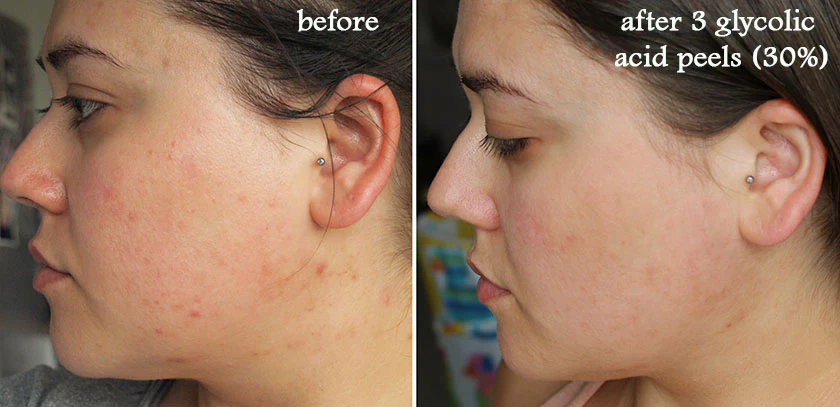 Glycolic Acid Chemical Peel