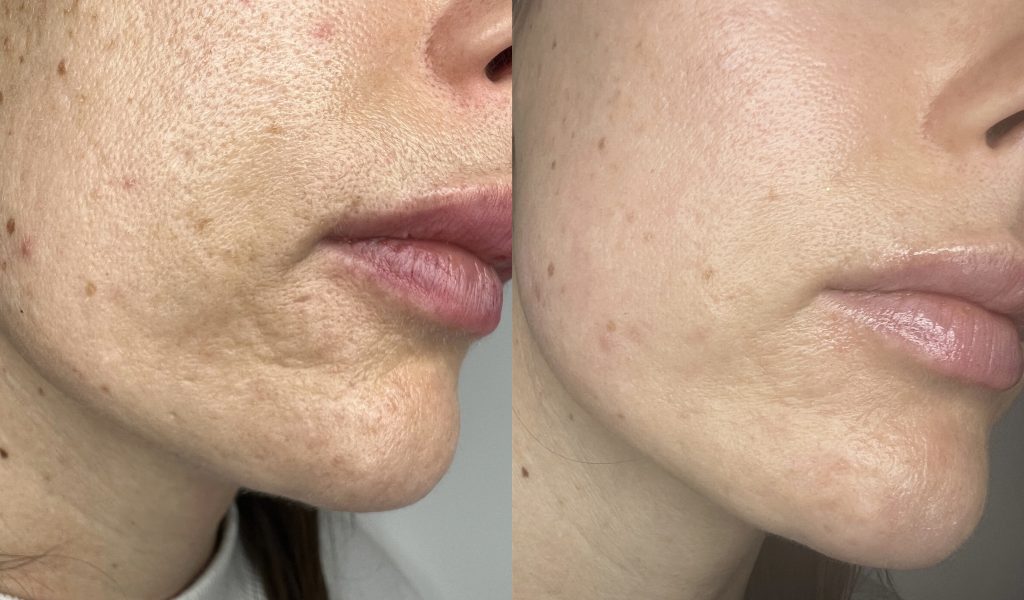 CO2 Laser Before and After
