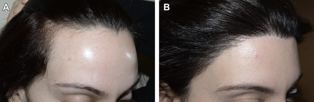 Hairline Removal