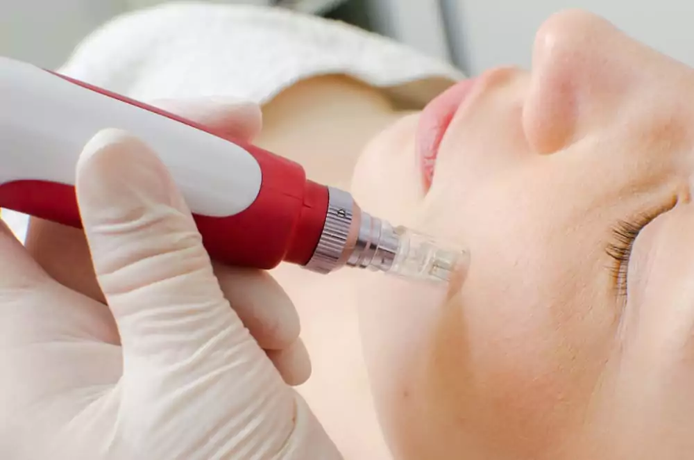 Microneedling at Home