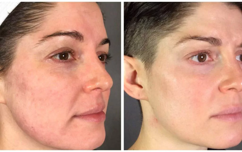 RF Microneedling Before and After