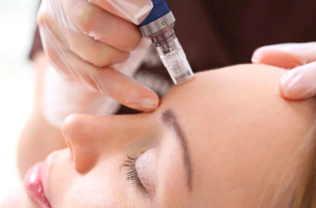 Microneedling Near Me